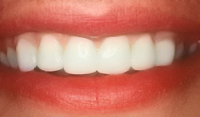Perfect Smile straight teeth